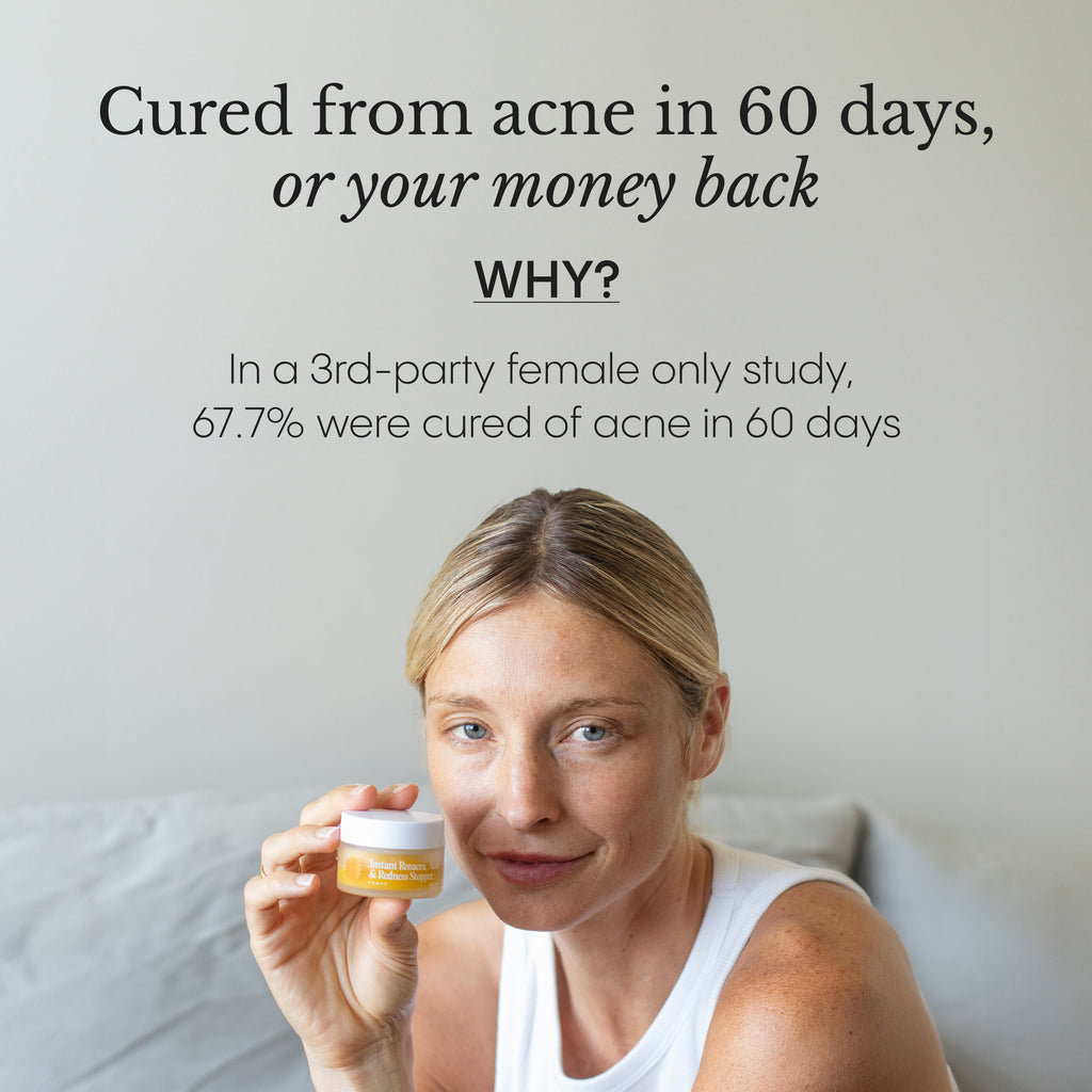 The Complete Acne System for Women