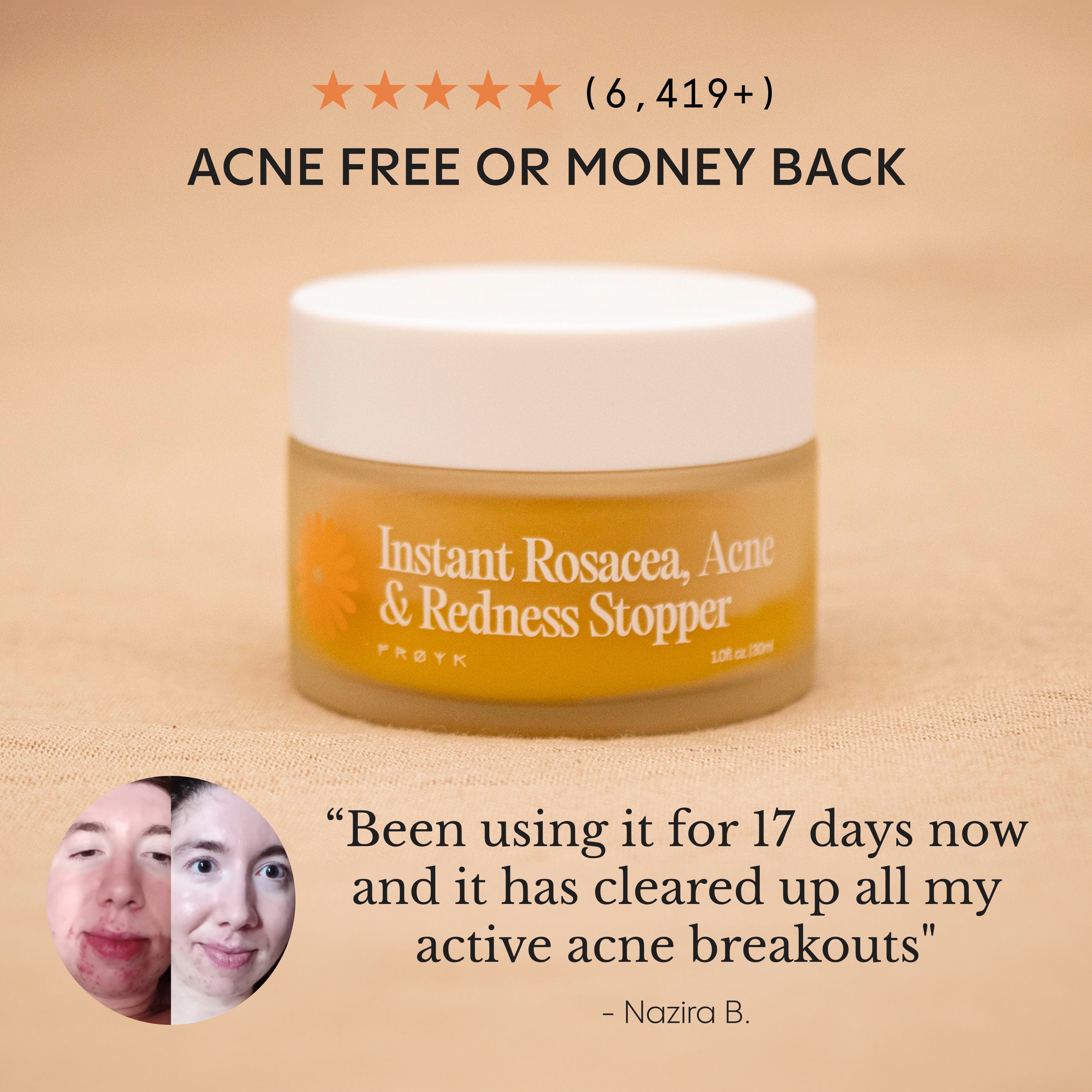 The Complete Acne System for Women